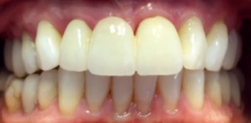 dental bridge - after