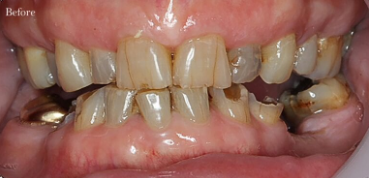 Dental crown - before
