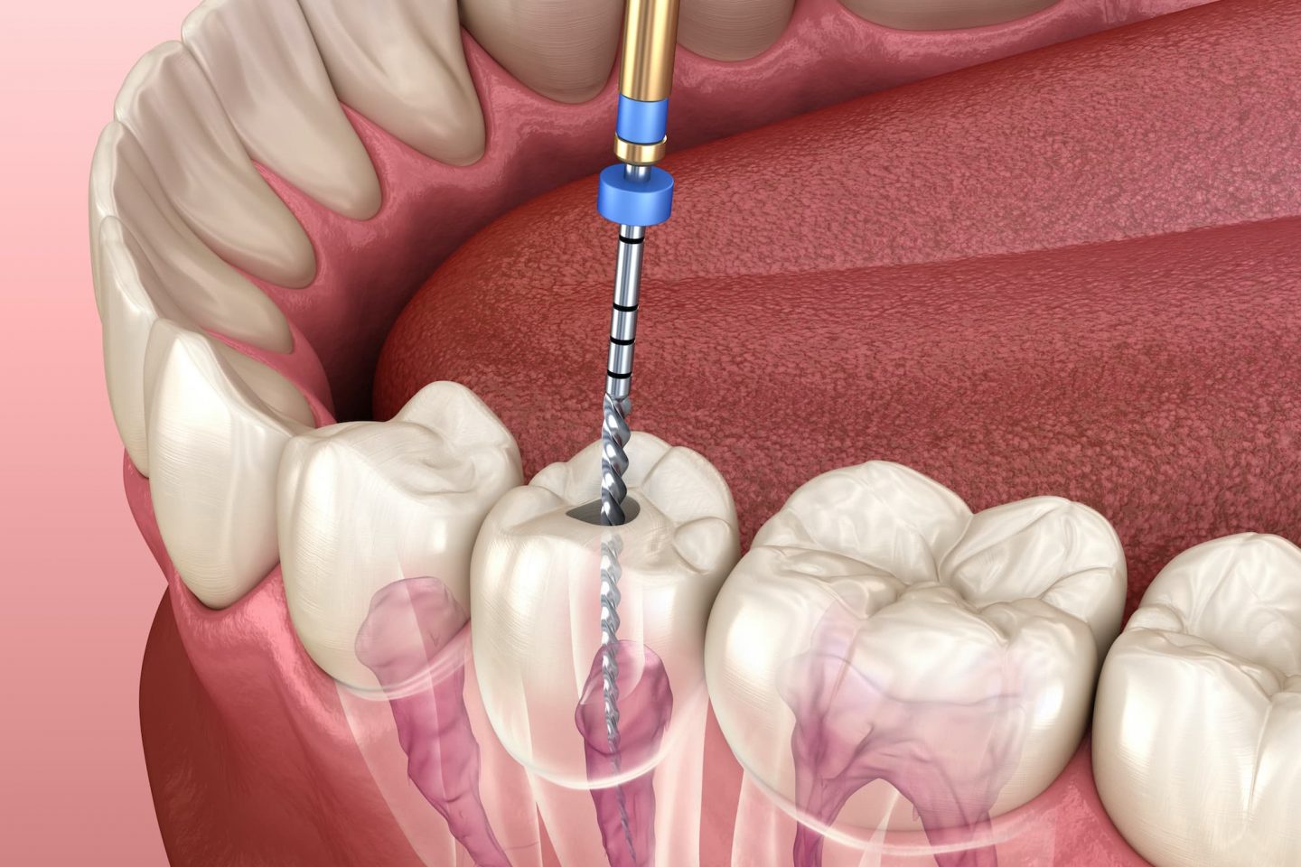 Root Canal Treatment in Dubai | Al Hana Modern Medical Center