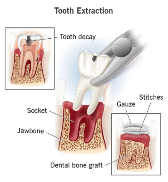 Tooth Removal