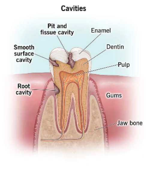 tooth filling