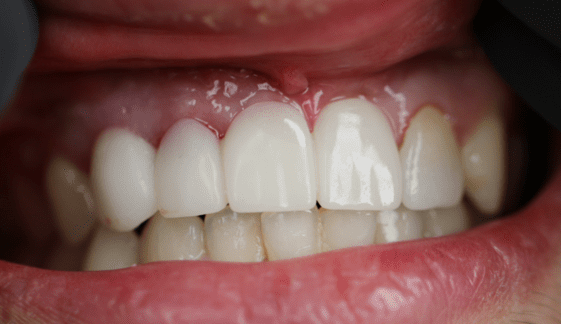 dental implant after