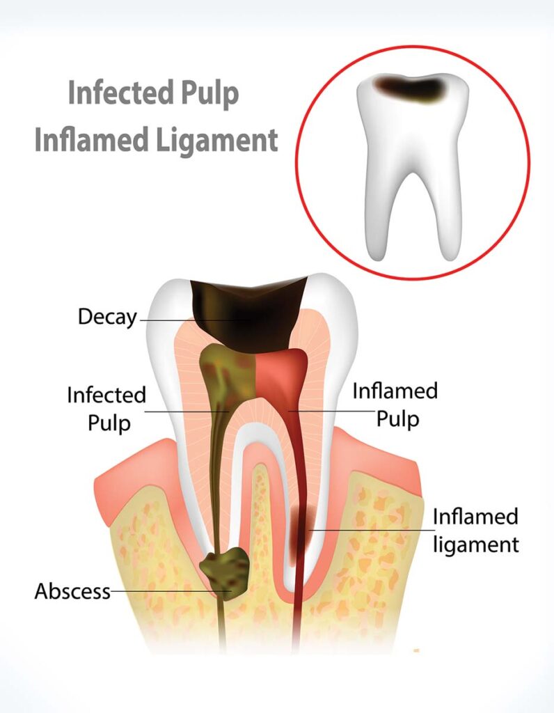 Root Canal Therapy