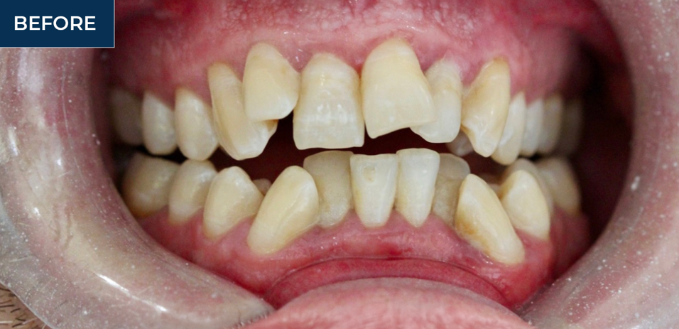 orthodontic braces before