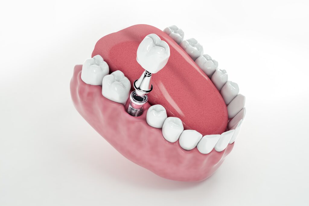 Dental Implant Treatment