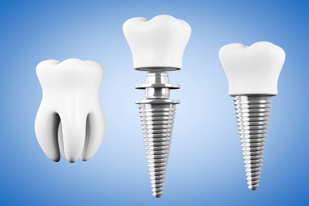 Dental implant specialist