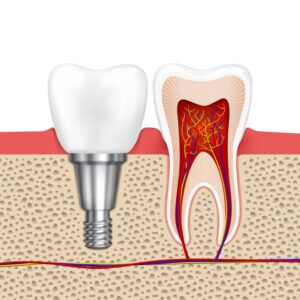 dental implant services in dubai